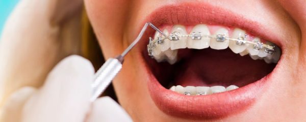 orthodontie adulte